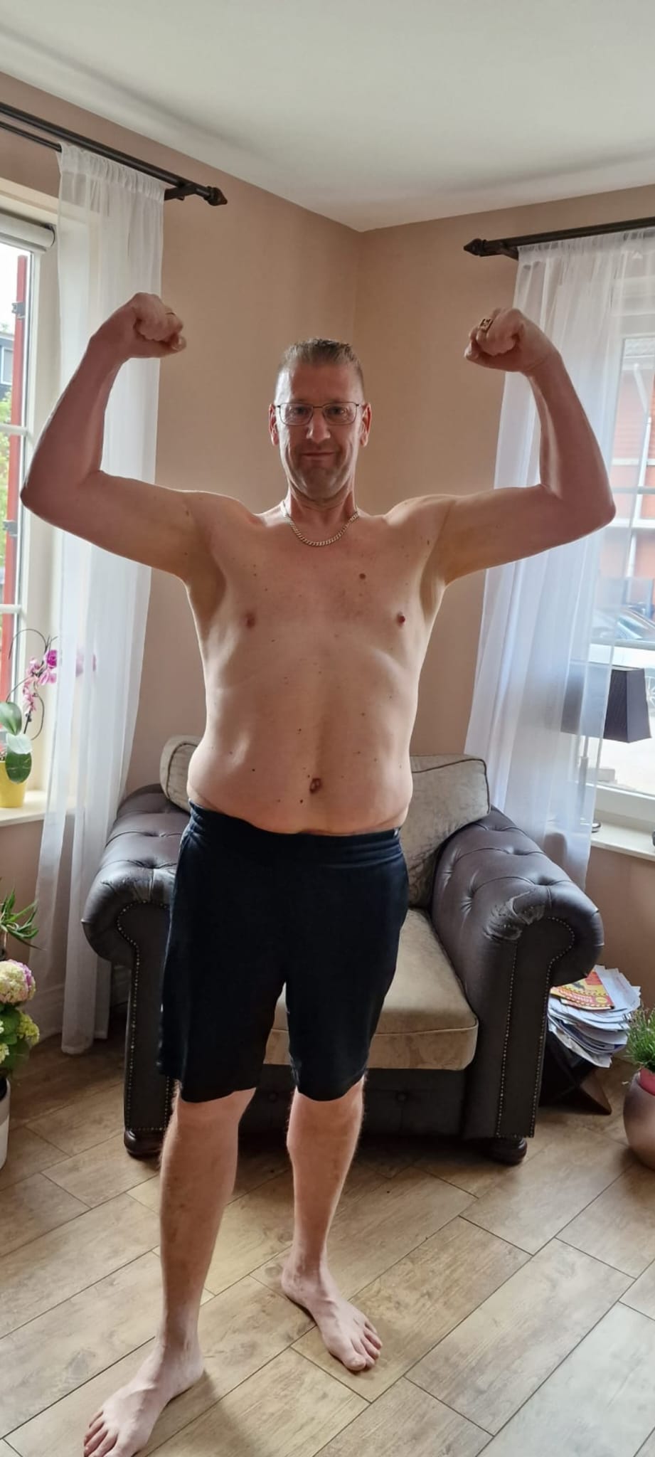 Tom Brons na buikwandcorrectie